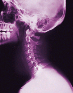 Normál állapotú nyaki gerinc röntgenfelvétele